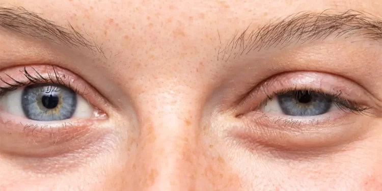 Sonbahar Mevsiminde Kontakt Lens Kullanımı: Dikkat Edilmesi Gerekenler